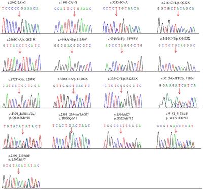 Clinical manifestations of 17 Chinese children with hereditary spherocytosis caused by novel mutations of the ANK1 gene and phenotypic analysis